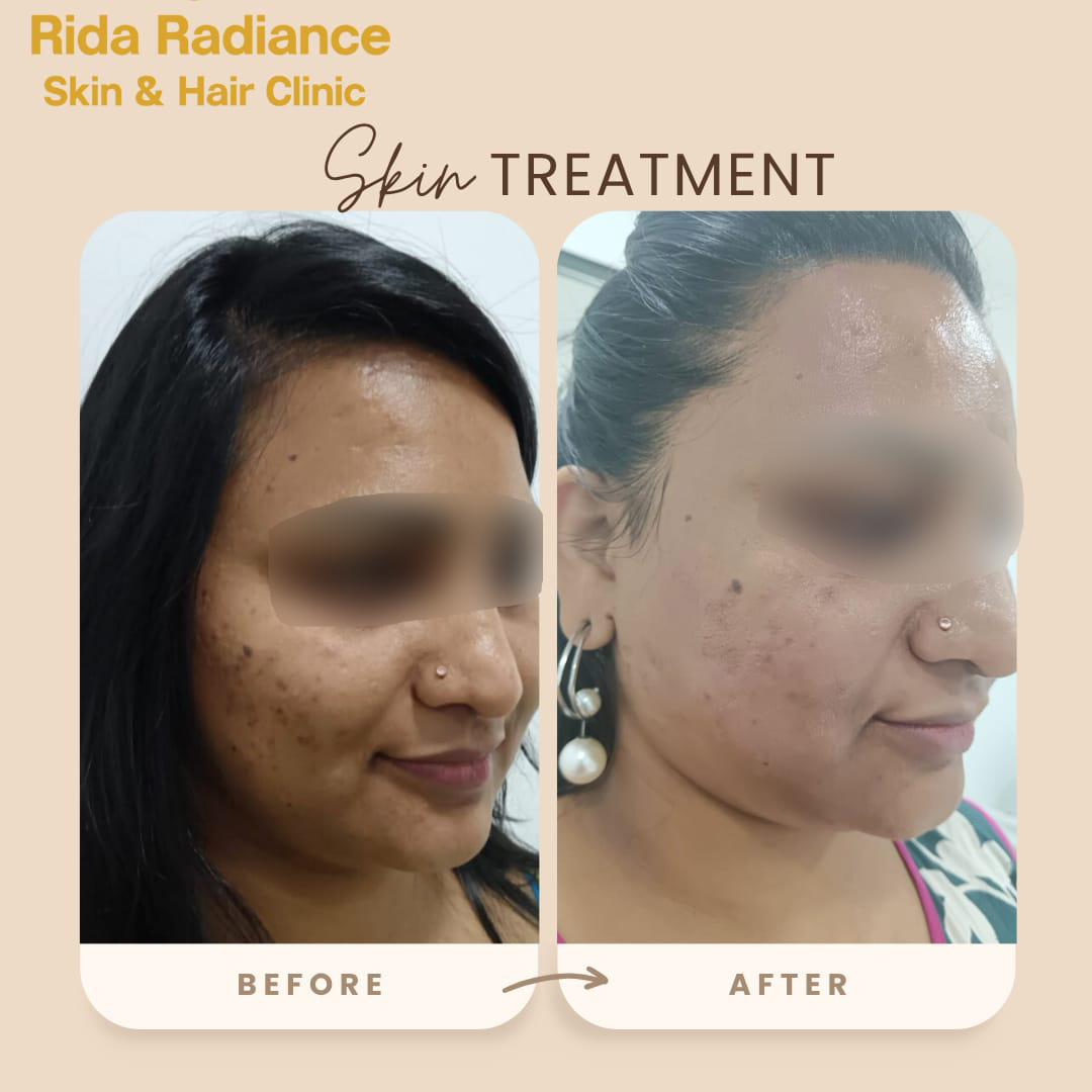 Chemical peel before and after